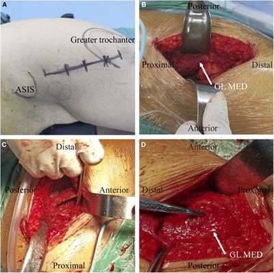 Early clinical outcomes of bipolar hemiarthroplasty for femoral neck fractures in elderly patients using the OCM approach: a retrospective study